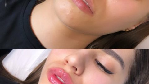 Kwas hialuronowy w super cenie! juz od 250 zł