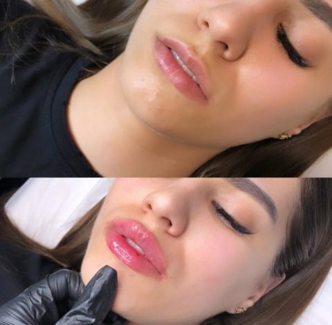 Kwas hialuronowy w super cenie! juz od 250 zł